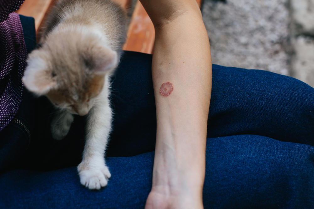 Ringworm fungal infection on a person's arm, a common cat-transmitted skin condition