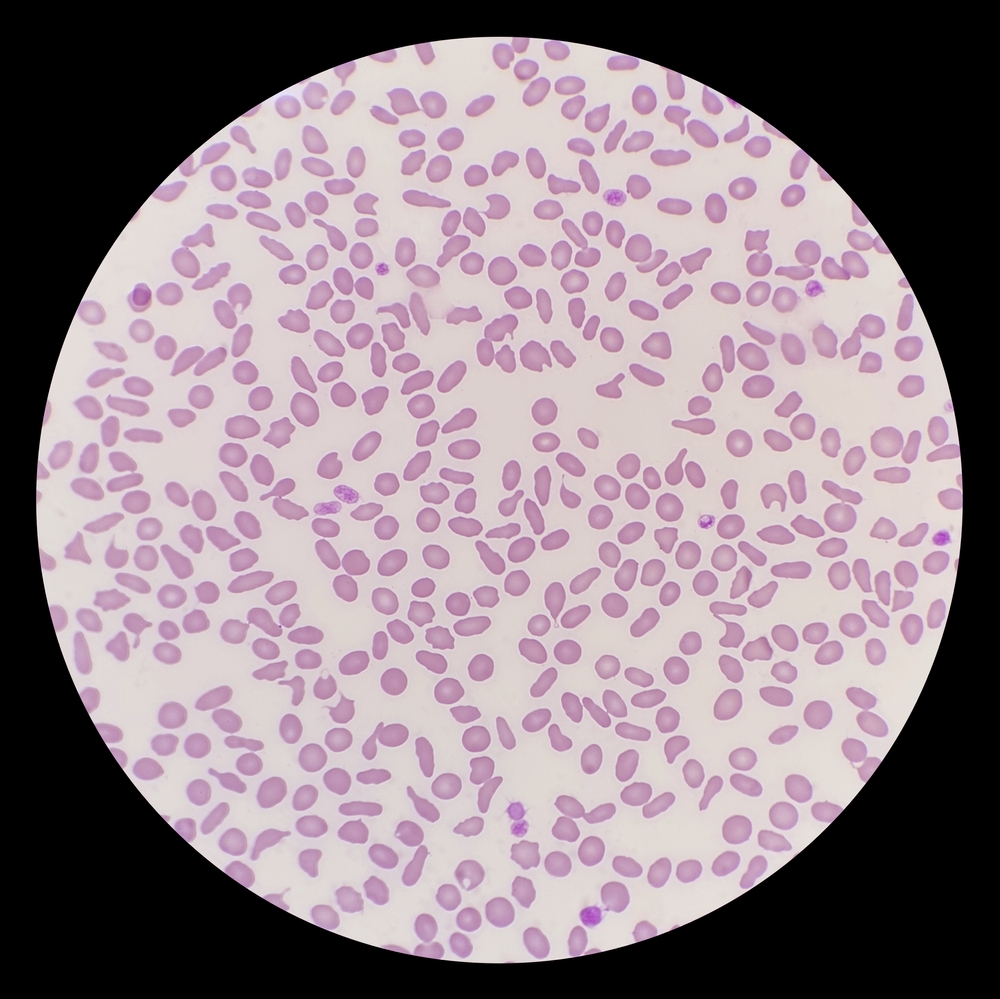 Microscope view of abnormally shaped red blood cells — veterinary diagnostic blood work analysis